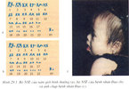 Bo_NST_cua_nam_gioi_binh_thuong_a_bo_NST_cua_benh_nhan_Dao_b_va_anh_chup_benh_nhan_Dao_c.jpg